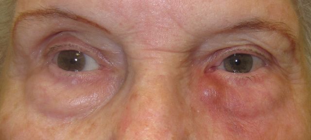 Acute Dacryocystitis - Lacrimal duct infection